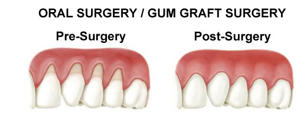 Costa Rica Oral Surgery - Gum Graft