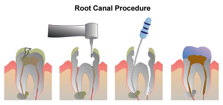 Costa Rica Root Canal Procedure
