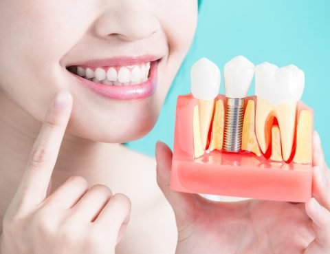 dental implant care