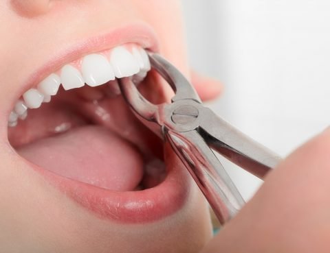 tooth extraction