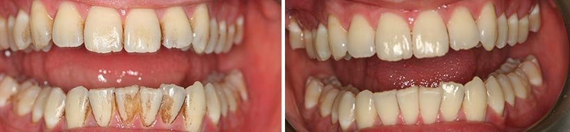 Teeth Cleaning Costa Rica Before After