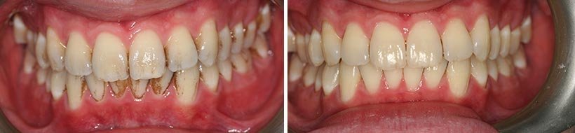 Teeth Cleaning Costa Rica Before After